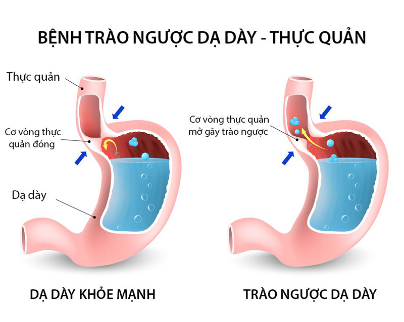 Trào ngược dạ dày thường gây ra ợ nóng, hôi miệng ở người bệnh